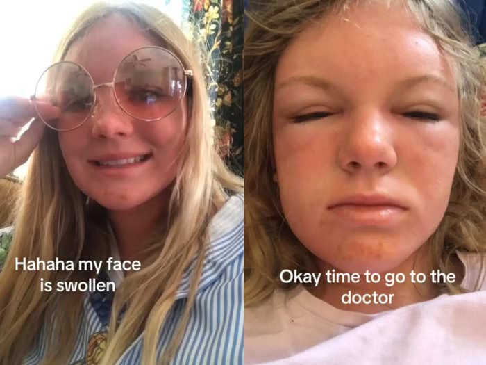 A woman's horrific sunburn is teaching people about sun poisoning and serving as an essential PSA to wear sunscreen this summer