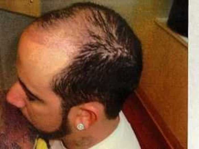 Backstreet Boy Posts Before-And-After Hair Transplant Photo