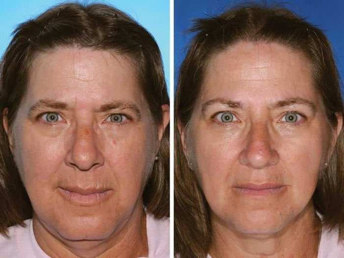 Shocking Photos Of Identical Twins Shows How Smoking Destroys The Face