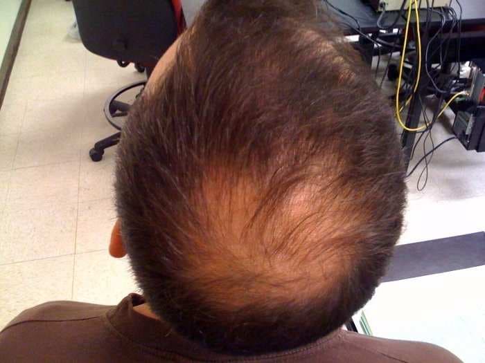 An experimental treatment wants to harness the power of stem cells to treat baldness