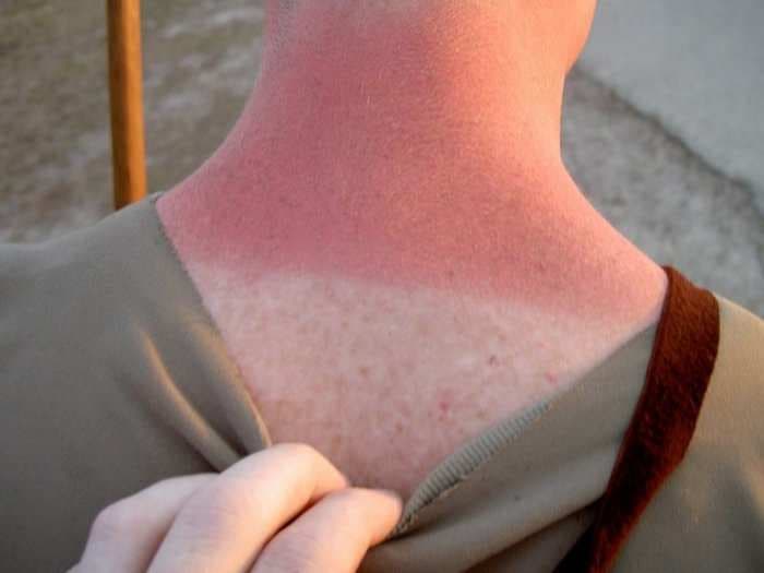 The 3 fastest ways to get rid of a painful sunburn, according to a licensed dermatologist