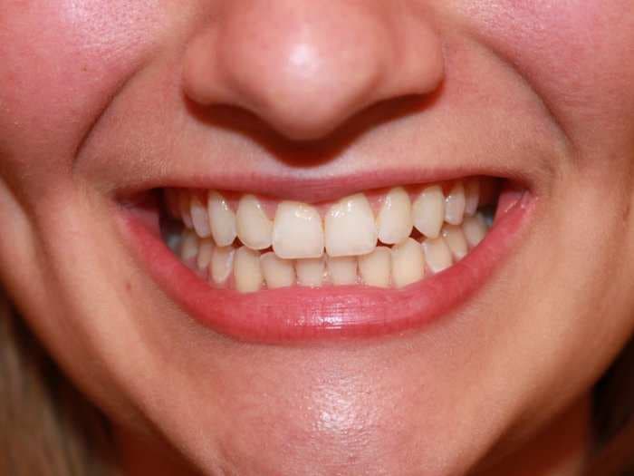 An estimated 90% of adults in the US have fillings - here's why we can't just regrow our teeth