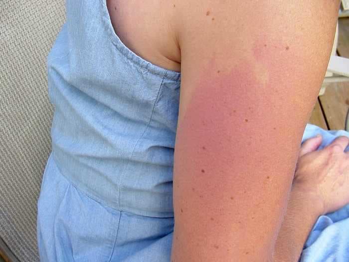 Getting a 'COVID arm' rash after the Moderna vaccine might be itchy, but it's no big deal
