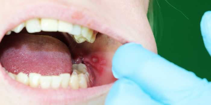 You'll likely get a canker sore 3 to 4 times per year- here's what causes them and how to treat