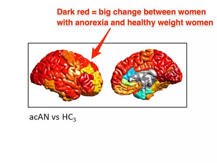 A new brain imaging study shows what anorexia does to a person's brain, and how weight gain appears to reverse the changes