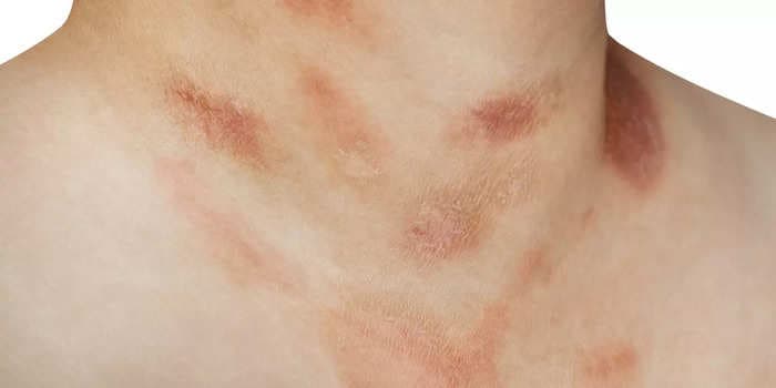 If you have an itchy rash that resembles a Christmas tree, you may have a common skin condition called pityriasis rosea