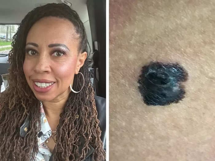 A woman thought a spot she'd had for years was a birthmark &mdash; until it started bleeding when she scratched it. It turned out to be stage 2 skin cancer.