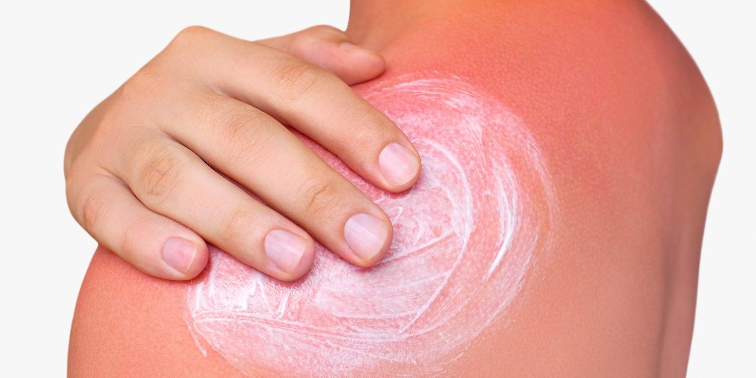 I got a sunburn and now my skin is peeling How To Stop Sunburn Itch 7 Ways To Soothe Your Skin