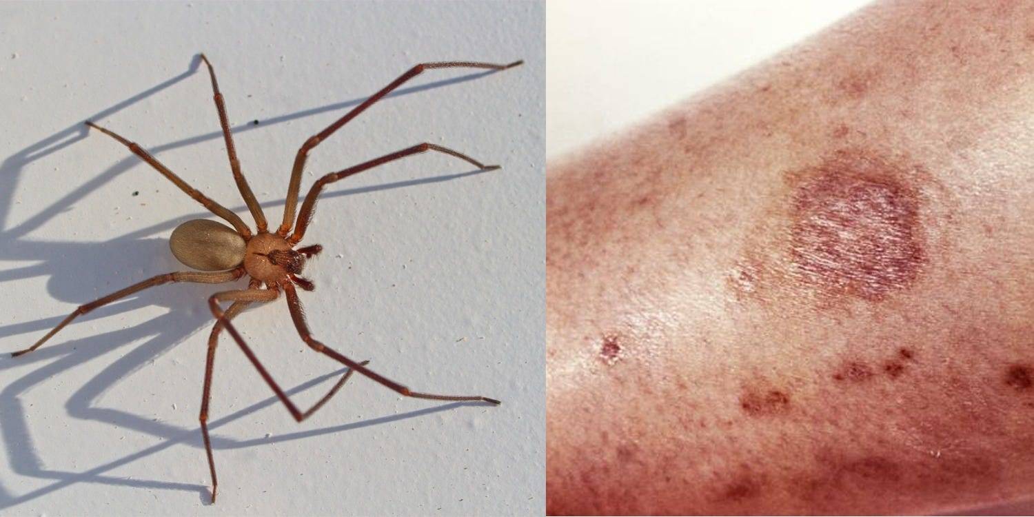 How To Treat A Spider Bite What Spiders Bites Are The Most Dangerous