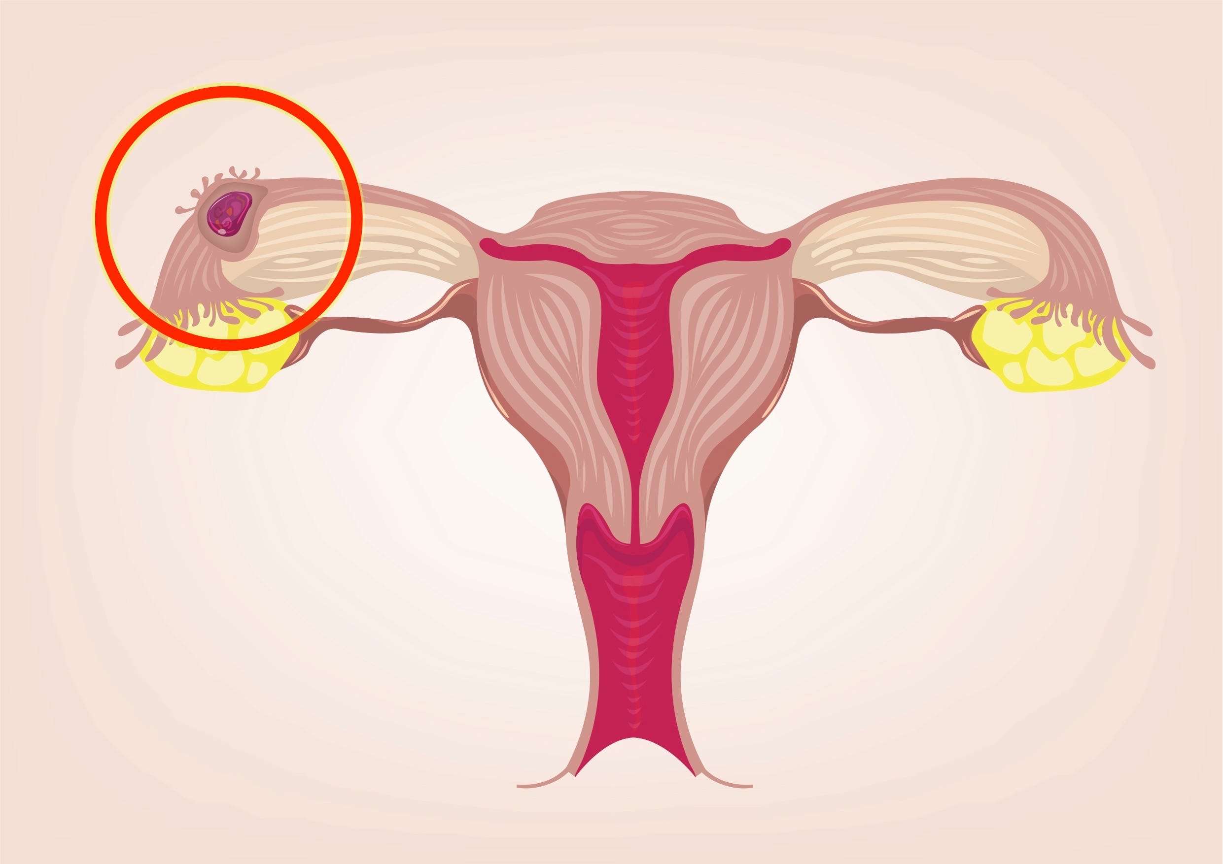 Болит яичник во время беременности. Матка внематочная беременность. Маточная беременность.