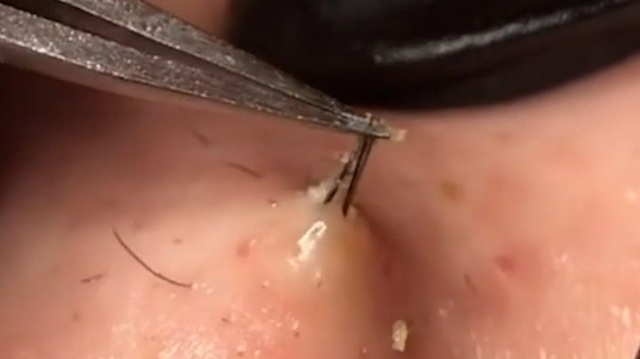 Watch how professionals remove ingrown hairs