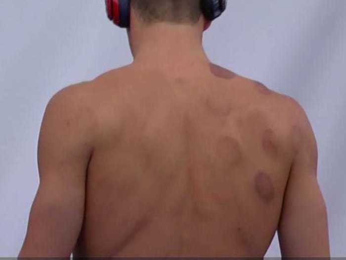 When Michael Phelps showed up to the 2016 Olympics with deep purple bruises dotted across his shoulders and back, much of the world was intrigued.