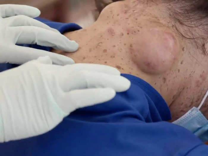 At the start of 2021, Dr. Pimple Popper squeezed 'mashed potatoes' out of a man's neck cyst.
