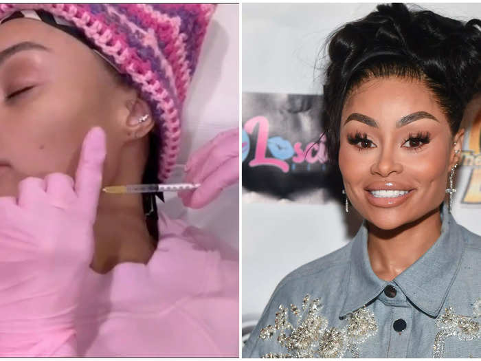 Blac Chyna shared a video of her doctor dissolving her facial fillers on Instagram in March 2023.